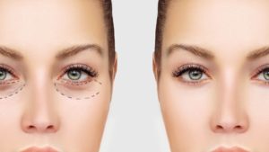 Can The Under Eye Bag Removal Surgery Remove The Under Eye Bag
