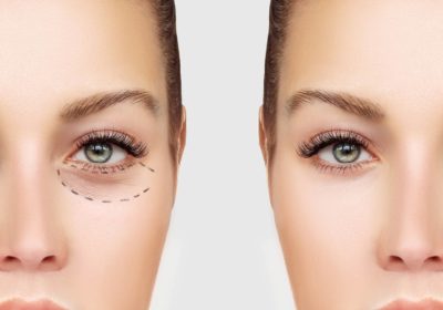 Can The Under Eye Bag Removal Surgery Remove The Under Eye Bag
